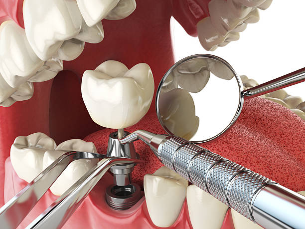 Best Emergency Denture Repair in Warsaw, IN