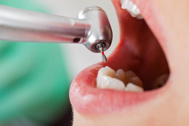 Best Emergency Wisdom Teeth Removal in Warsaw, IN